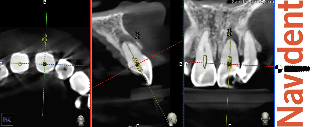 Figs. 17a–c: Planning of the virtual guide for the left incisor. The axis and depth of the preparation are shown.
