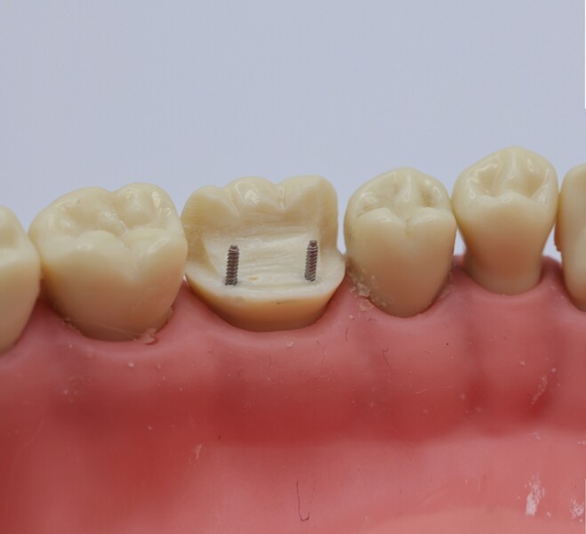 Fig. 6a: Completed pinlay preparation on tooth #36 with the two dentine pins in place, shown in lingual view. 
