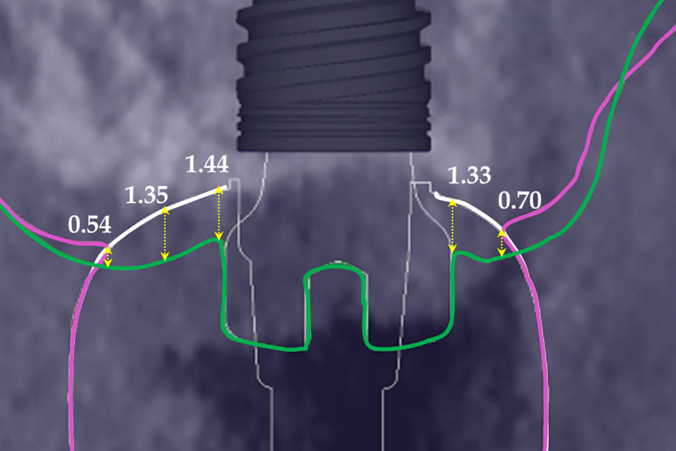 Fig. 7a: Dimensions (mm) of the gingiva at prosthesis delivery. The prosthesis (white line) compressed the soft tissue as evident from the changes in the gingival height between the end of the healing (green line) and prosthesis delivery (purple line).