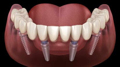Forschungsprojekt zur Lebensdauer von Zahnimplantaten Forschungsprojekt zur Lebensdauer von Zahnimplantaten