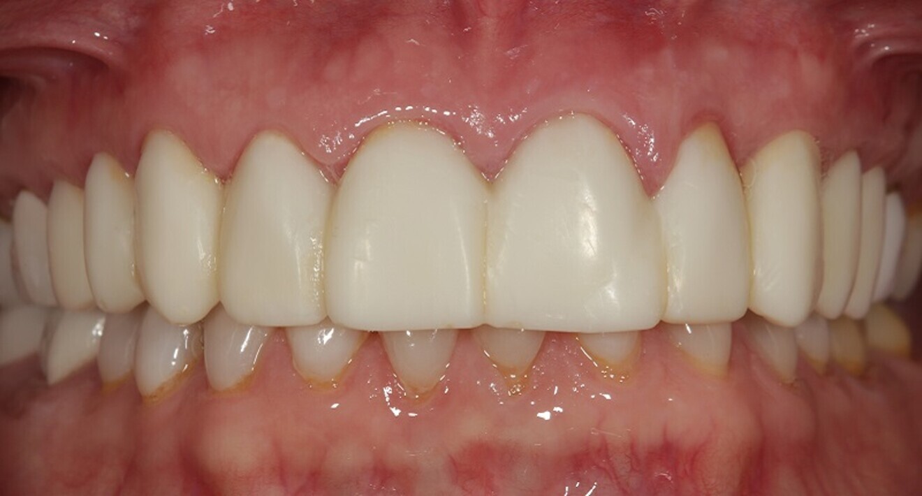 Fig. 2: Retracted view of initial provisional restorations made of Tuff-Temp Plus (Pulpdent) after removal of the existing restorations and registration of master impressions and interocclusal records.