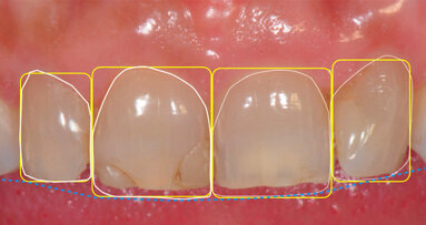 La programmazione  del ringiovanimento  del sorriso