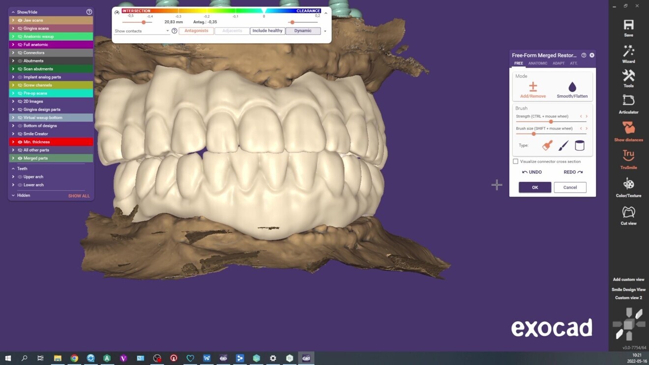 Fig. 11: Final try-ins in CAD software.