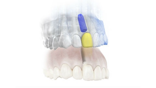 Dentsply Sirona – SIMPLANT e ATLANTIS