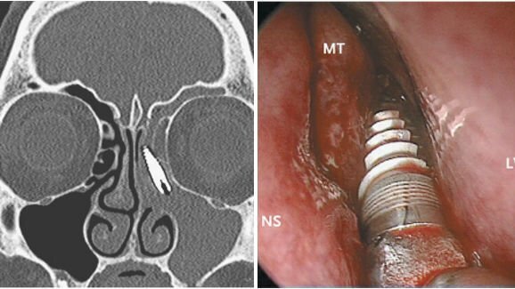 Zdravniki našli zobni implantat v nosni votlini