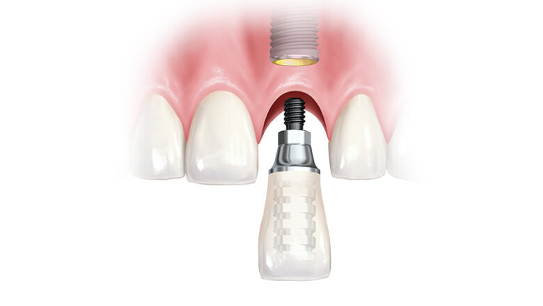 Okamžité zatížení implantátu