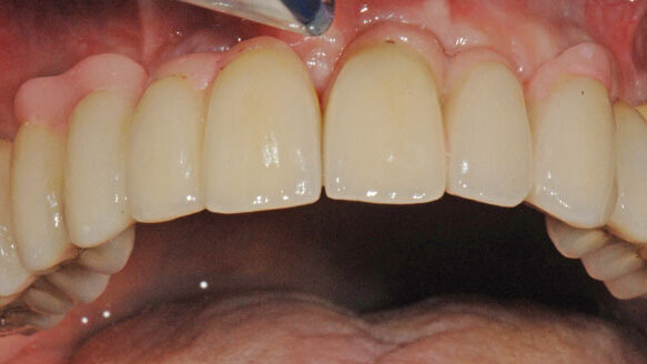 Edentulism: Implant prosthesis therapies designed to optimize function, esthetics