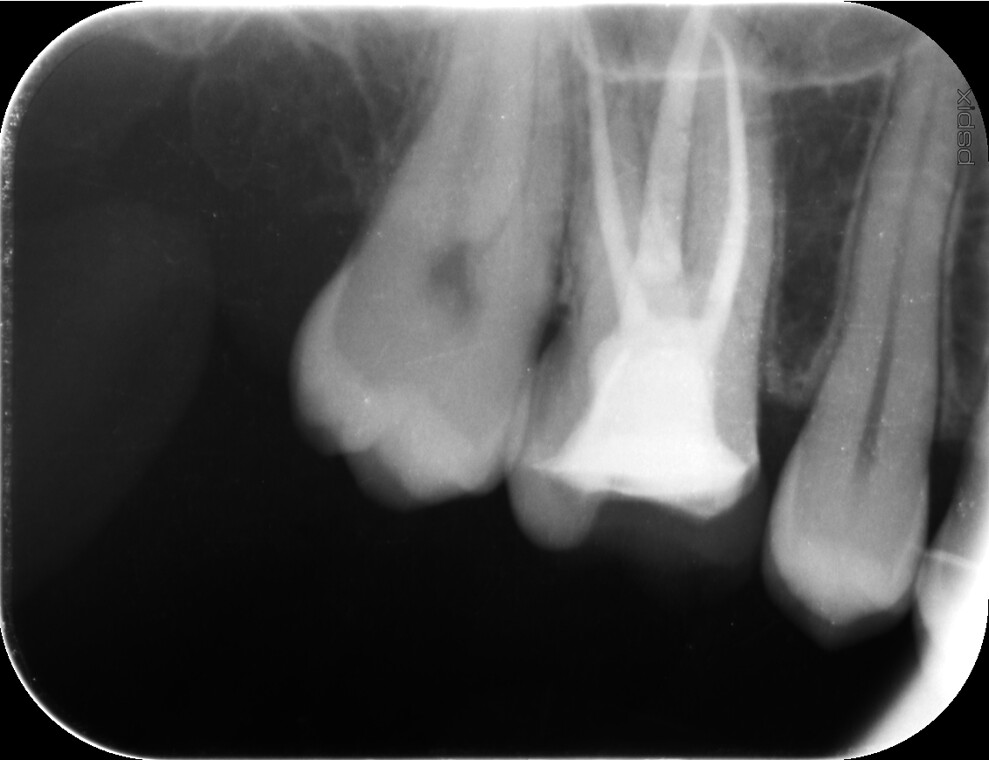 Fig. 32: Final radiograph.