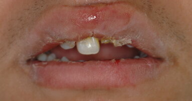 Reconstrucción inmediata de dientes con destrucción avanzada