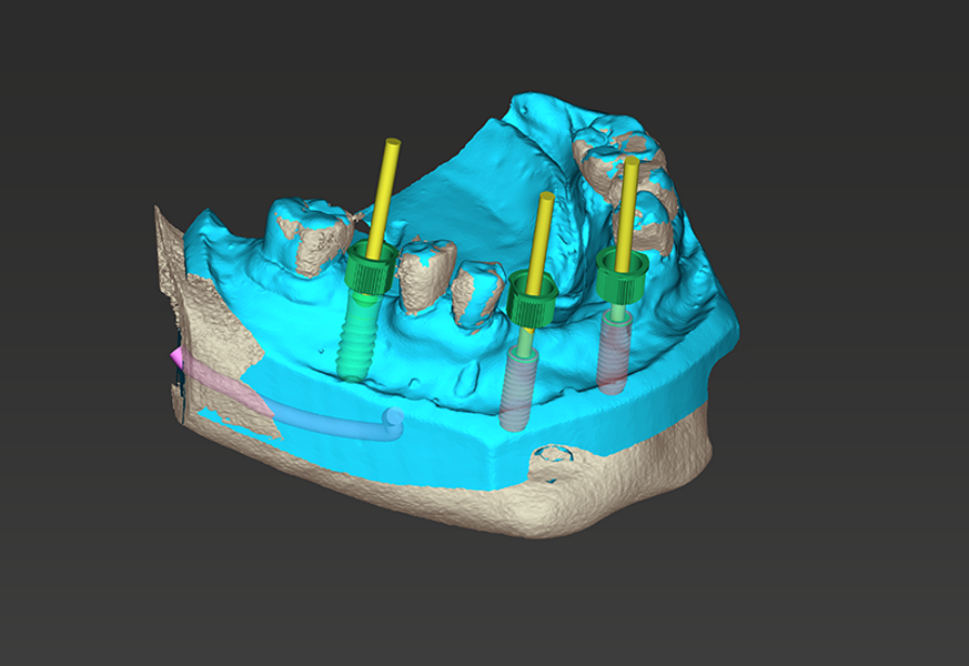 coDiagnostiX implant placement