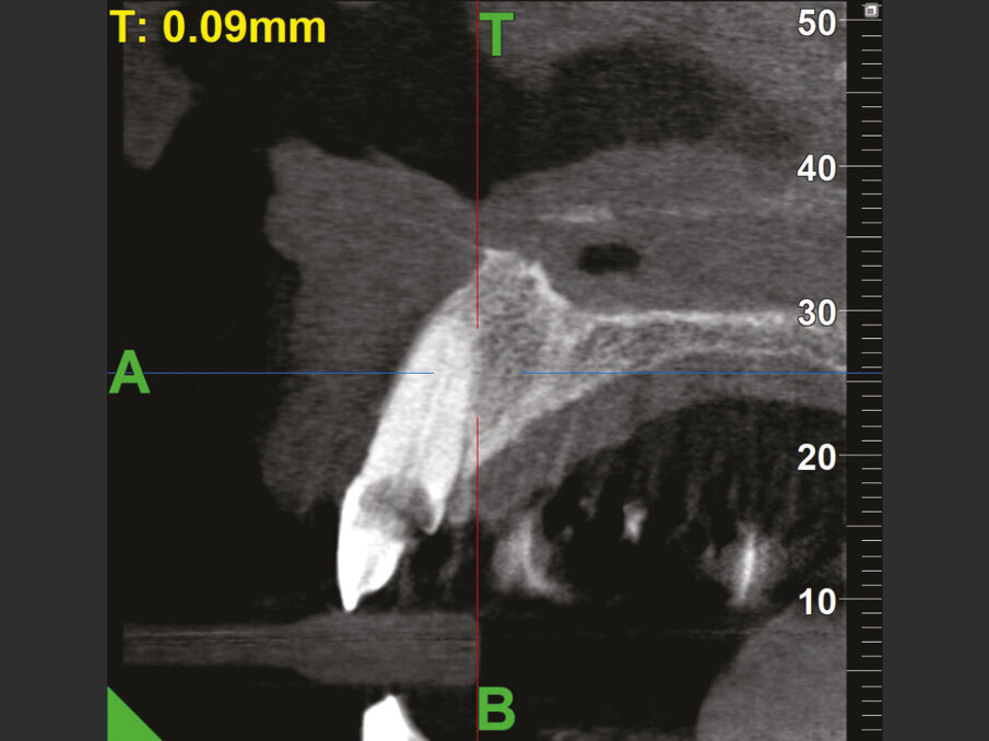 Fig. 2b - CBCT iniziale con MyRay Hyperion X9 Pro.