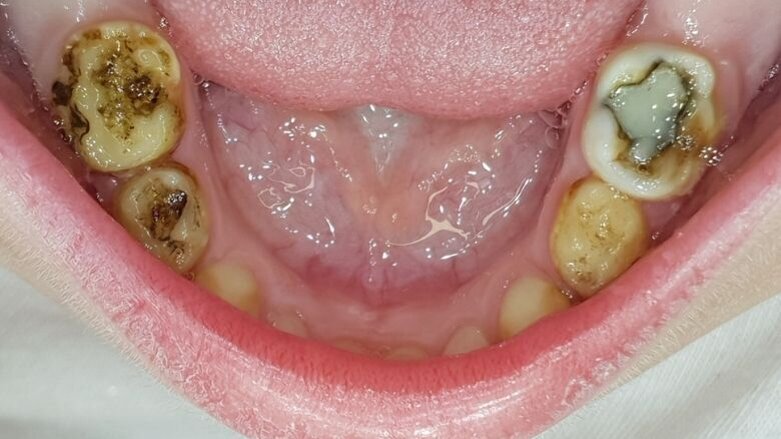 Indicatie narcose bij kinderen te vaak ongegrond