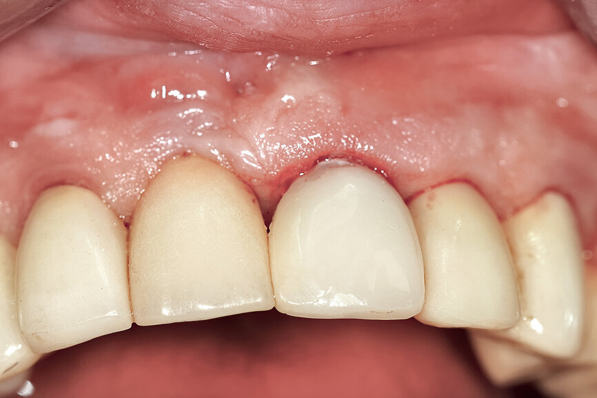 Fig. 26d: The soft-tissue contours were excellent; no sutures were required for the transitional restoration.