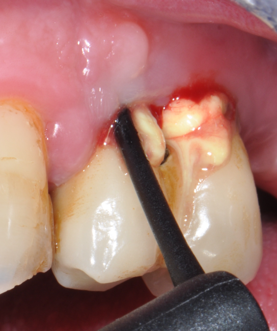 Fig.19: Case 2. Second application of doxycycline 14%.