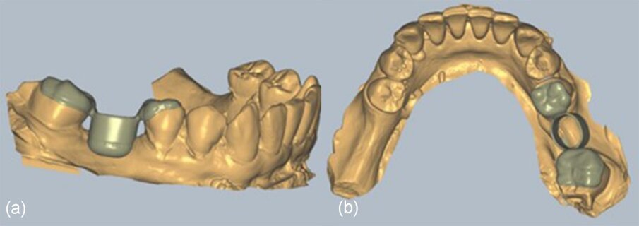 Fig. 19_L’unità di profilo con la scanalatura di trattenimento a livello della mucosa marginale generata con gli strumenti di Exocad.