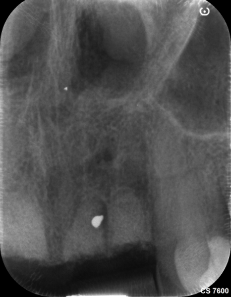 Fig. 5: Intra-oral radiograph after the extractions and ridge preservation.