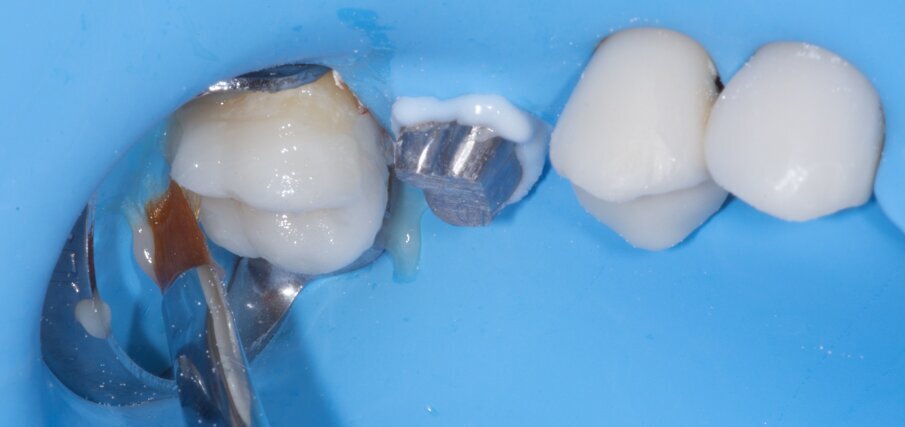 Fig. 15: Removal of excess composite. 