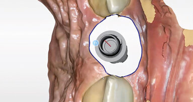 Management měkkých periimplantátových tkání pomocí kolagenní matrix a digitálního postupu