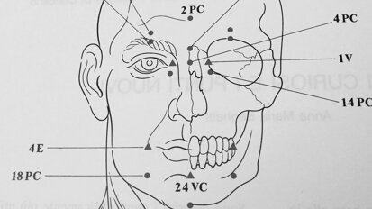 Lesione parziale del NAI: trattamento coadiuvante di un caso con agopuntura