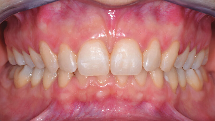 Figg. 10c, 10d_Foto extraorali ed intraorali di fine trattamento.