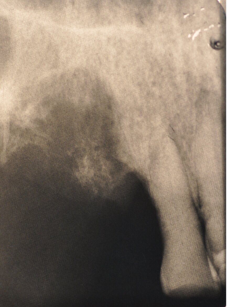Ryc. 1-3_Stan przed leczeniem: 2. Zdjęcie rtg okołowierzchołkowe