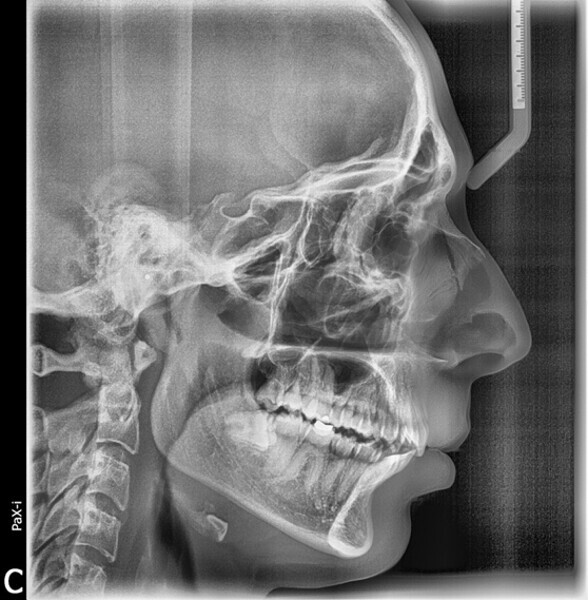 Fig. 18: Cephalometric radiograph taken after the orthodontic treatment.