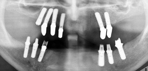 Fig. 6. Orthopantomograph. After placement of implant #44.