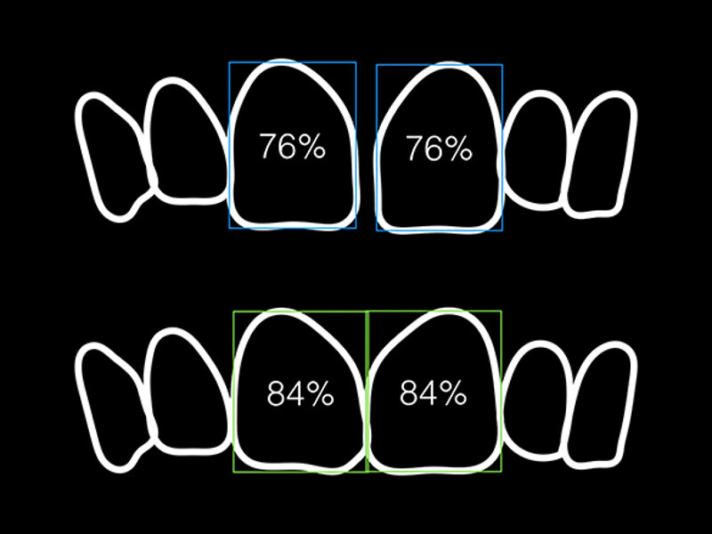 Figura 2. Proporciones reales e ideales de los incisivos centrales.