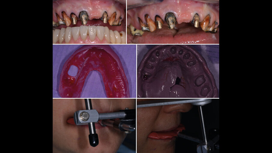 Fig. 9 - Preparazione dei monconi superiori, impronte e arco facciale.