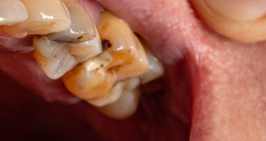 El 94% de los adultos en España tiene caries