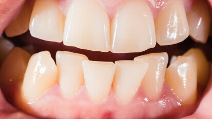 Early-life stress may lead to crooked bite