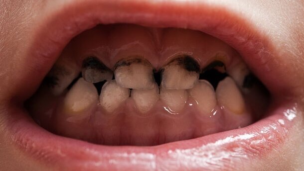 Les bactéries cariogènes peuvent persister chez les enfants après le traitement de caries