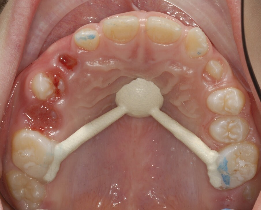 Fig. 27_Nance bondata ed estrazioni anticipate decidui.