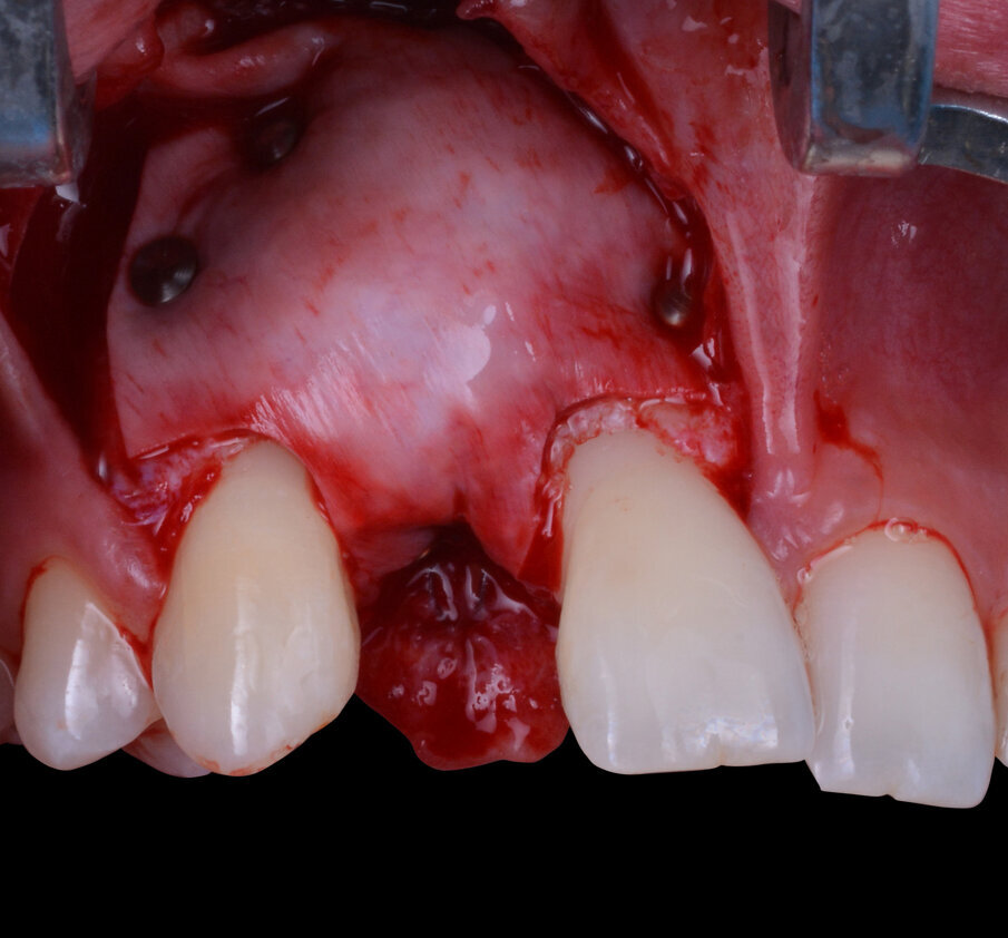 Fig. 8 - Stabilizzazione del complesso innesto-membrana.