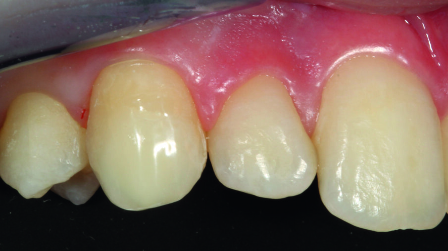 Afbeelding 10. Restauratie met OMNICHROMA: het materiaal was in staat om de resterende ondoorzichtige gebieden goed te bedekken.