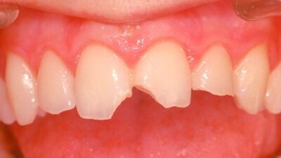 Il punto di vista dell’odontologo forense nella valutazione dei traumi dentali