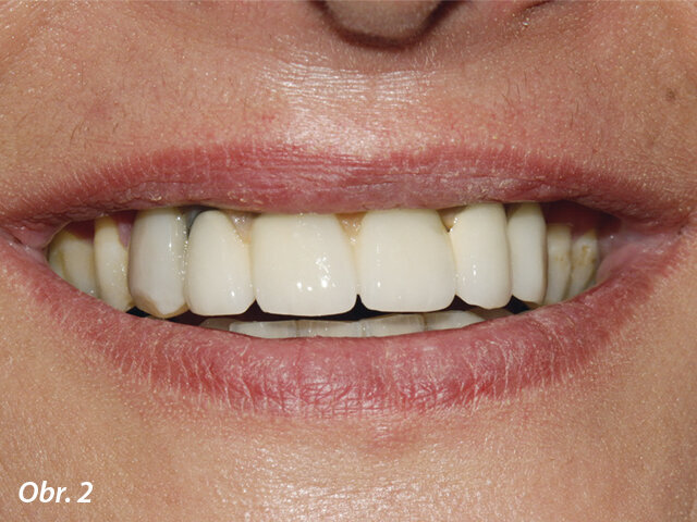 Prvotní náhrada: opora rtu byla zajištěna rozsáhlou umělou gingivou a u pravého horního špičáku bylo patrno odlomení estetického materiálu. Úsměv pacientky odhaloval protetické zuby umístěné mimo středovou osu a prosvítání konstrukce u pravého postranního řezáku.
