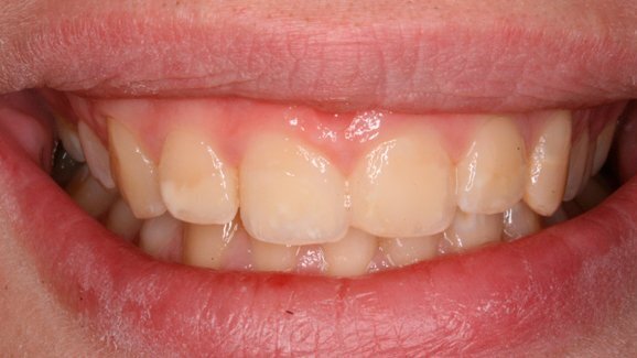 Riabilitazione estetica con resine composite in caso di severa Molar Incisor Hypoplasia: case report