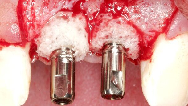 Augmentation: Specialist presents bone ring technique