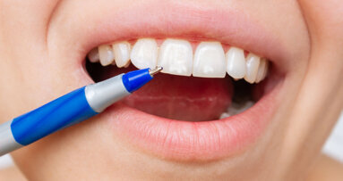 Conservative aesthetic management of white spot fluorosis lesions