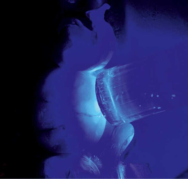 Fig. 10. Polimerización final. Previamente se eliminaron los excesos del material de cementación (técnica de cuadrantes).