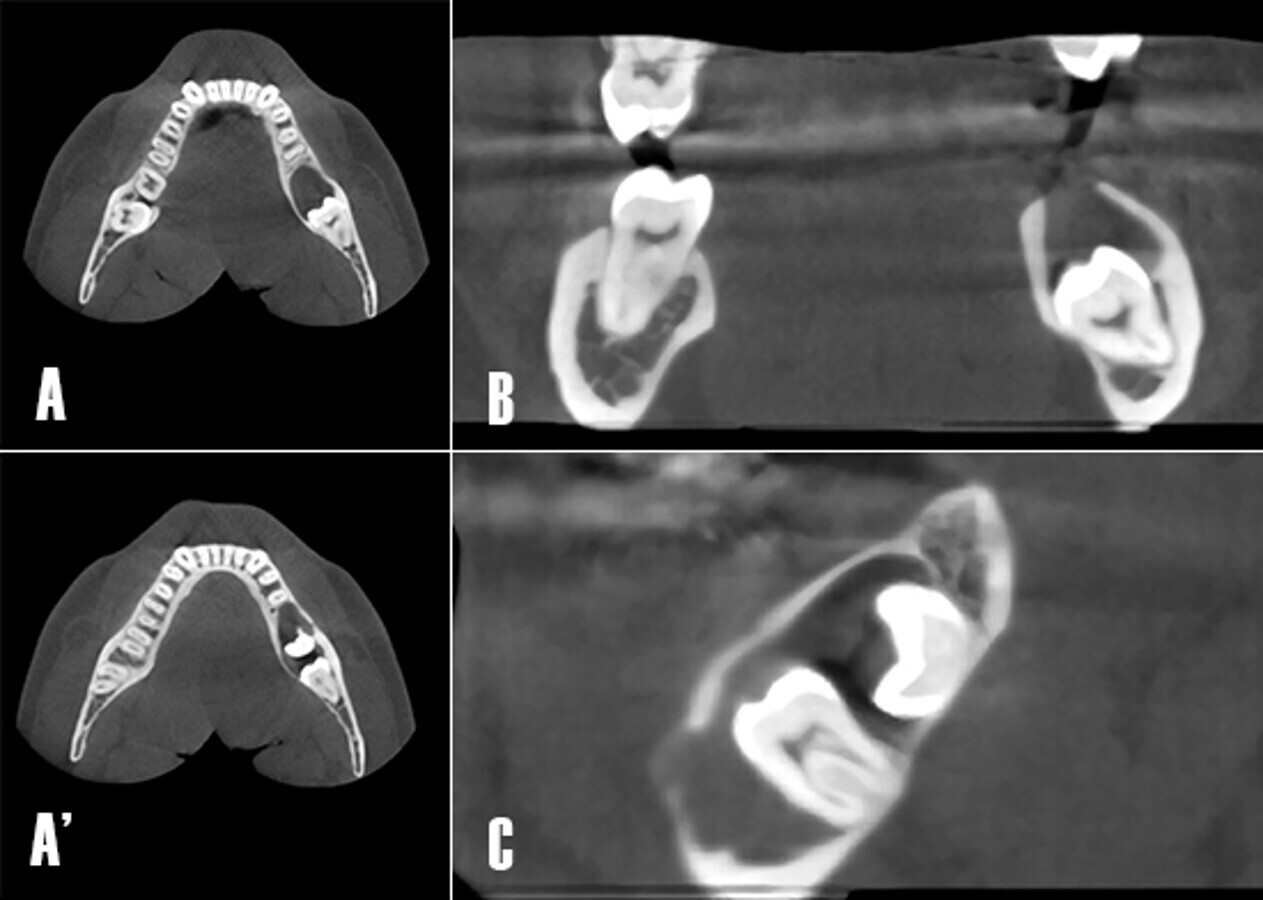 Figura 3. TomografÃ­a computarizada de haz cÃ³nico. A) Corte axial. NÃ³tese como la extensiÃ³n de la lesiÃ³n osteolÃ­tica se extiende en sentido antero posterior afectando la raÃ­z distal de 3.6. AÂ´) Corte axial. En un corte mÃ¡s apical se visualiza la parcialmente la corona de 3.7, y una mayor extensiÃ³n de la lesiÃ³n en sentido antero-posterior hasta distal de 3.5. B). Corte coronal. Se observa cÃ³mo la lesiÃ³n osteolÃ­tica ha comprometido la integridad de la cortical en sentido craneal. C) Corte axial. La zona poco radiodensa estÃ¡ relacionada a los dientes 3.7 y 3.8 no erupcionados.