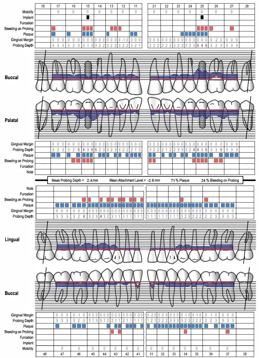 Fig. 2 - Charting parodontale al baseline.