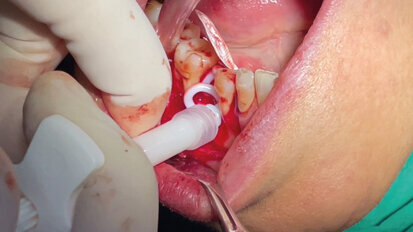 Rigenerazione ossea tramite membrana non riassorbibile e materiale alloplastico nella perdita di volume parodontale post-estrattiva