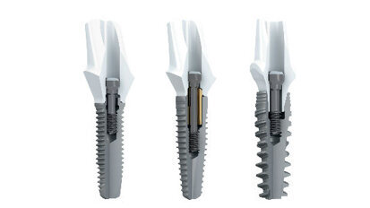 Nobel Biocare annuncia collaborazione con 3Shape