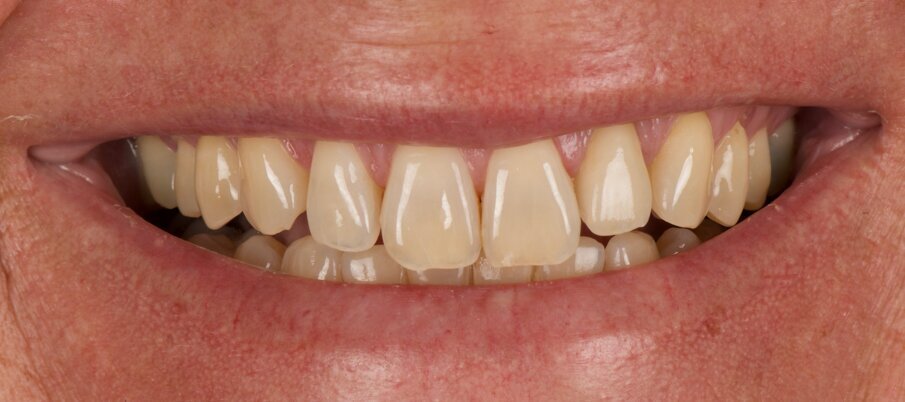 Fig. 10: Clinical situation one month after placement of the definitive restoration. Note the preservation of the tissue volume and the gingival margin.