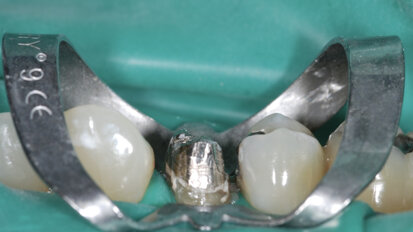 Retrouver l’accès aux canaux lors d’un retraitement