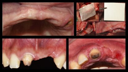 Piezocirugía  (11). Casos clínicos de terapia ósea regenerativa con piezoeléctrico