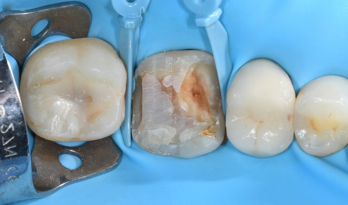 Fig. 2: Tooth #46 after removal of the old restoration under dental dam isolation to assess the extent of the carious lesion.