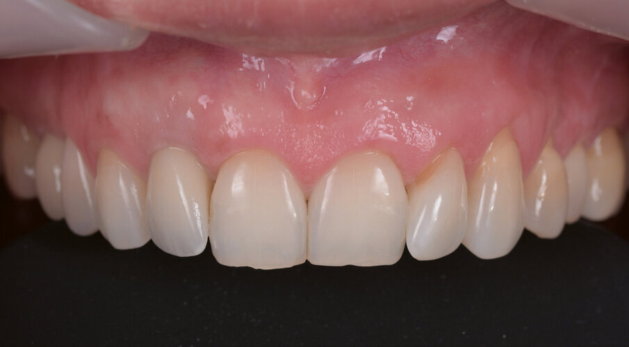 Fig. 15. Close-up of the final situation